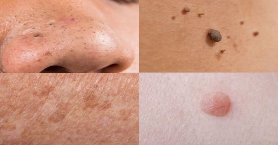 This Is How To Remove Age Moles, Spots, Blackheads, Warts, And Skin Tags Completely